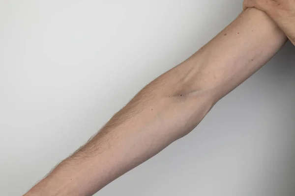 Male Drug Addict Shows His Hands Veins Which Show Bruises — Stock Photo, Image