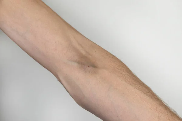 一名男性瘾君子的手和静脉显示出注射后的瘀伤 药物依赖和注射到静脉中的概念 — 图库照片