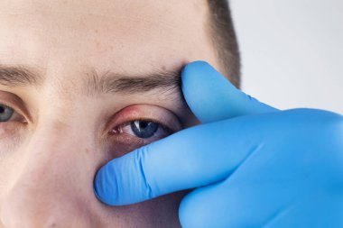 Doktor, kanaması olan bir hastayı muayene ediyor. Göz kapağının kızarıklığı ve iltihap tedavisi. Gözlerin etrafındaki deri enfeksiyonu. Kaliteli tıbbi bakım konsepti
