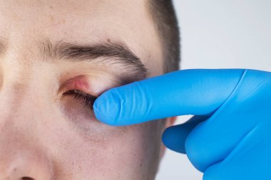 Doktor, kanaması olan bir hastayı muayene ediyor. Göz kapağının kızarıklığı ve iltihap tedavisi. Gözlerin etrafındaki deri enfeksiyonu. Kaliteli tıbbi bakım konsepti