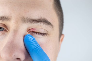 Doktor, kanaması olan bir hastayı muayene ediyor. Göz kapağının kızarıklığı ve iltihap tedavisi. Gözlerin etrafındaki deri enfeksiyonu. Kaliteli tıbbi bakım konsepti