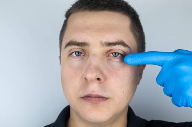 Doktor, kanaması olan bir hastayı muayene ediyor. Göz kapağının kızarıklığı ve iltihap tedavisi. Gözlerin etrafındaki deri enfeksiyonu. Kaliteli tıbbi bakım konsepti