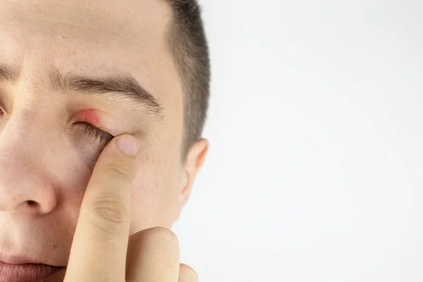 Man Stands Front Mirror Sees Inflammation Upper Eyelid Redness Skin — Stock Photo, Image