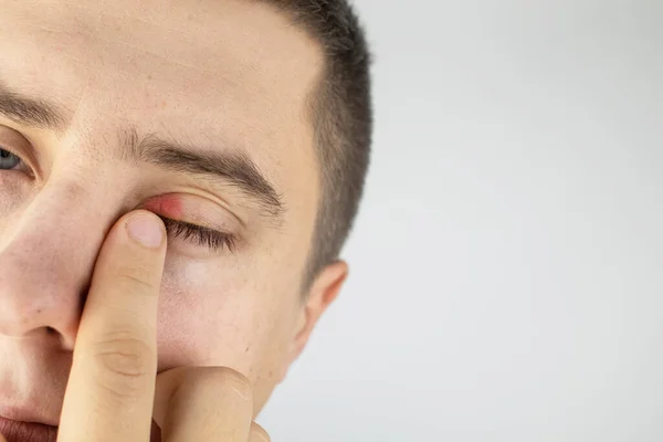 Hombre Para Frente Espejo Inflamación Del Párpado Superior Enrojecimiento Piel —  Fotos de Stock