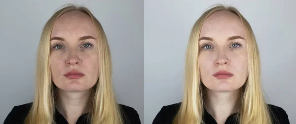 女の子の前と後の写真 左側はにきびと拡大毛穴を持つ顔の写真で 右側はきれいな顔です 黒い点 女性の鼻と頬に詰まった毛穴クローズアップ — ストック写真
