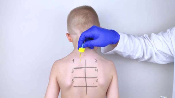 Een Allergist Het Laboratorium Doet Een Allergie Prik Test Huidtest — Stockvideo