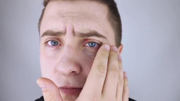 Egy Férfi Áll Tükör Előtt Gyulladást Lát Felső Szemhéjon Bőr — Stock videók