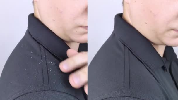 Dandruff Sebelum Dan Sesudah Pria Sebelah Kiri Menunjukkan Bahunya Yang — Stok Video