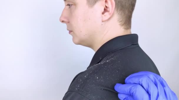 Dandruff Man Shoulder Side View Man Who Has More Dandruff — Stock Video