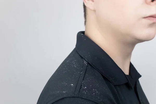 Dandruff on a man\'s shoulder. Side view of a man who has more dandruff flakes on his black shirt. Scalp disease treatment concept. Discomfort from a fungal infection