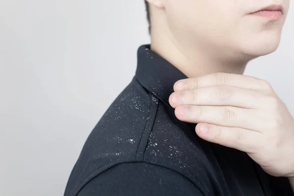 Dandruff on a man\'s shoulder. Side view of a man who has more dandruff flakes on his black shirt. Scalp disease treatment concept. Discomfort from a fungal infection
