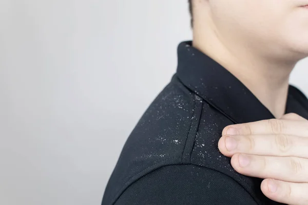 Dandruff on a man's shoulder. Side view of a man who has more dandruff flakes on his black shirt. Scalp disease treatment concept. Discomfort from a fungal infection