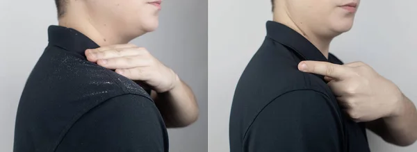 Dandruff on a man's shoulder. Side view of a man who has more dandruff flakes on his black shirt. Scalp disease treatment concept. Discomfort from a fungal infection