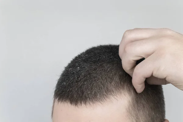 Dandruff on a man's shoulder. Side view of a man who has more dandruff flakes on his black shirt. Scalp disease treatment concept. Discomfort from a fungal infection