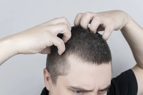 Dandruff on a man\'s shoulder. Side view of a man who has more dandruff flakes on his black shirt. Scalp disease treatment concept. Discomfort from a fungal infection