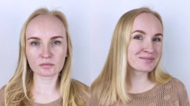 Önce ve sonra. Bir kadın yüzündeki kuru deriyi muayene eder. Soyulma, kabalaşma, rahatsızlık, cilt hassasiyeti. Dermatolog ya da kozmetikçinin randevusundaki hasta. Kuru deri parçalarının yakın çekimi