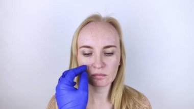 Bir kadın yüzündeki kuru deriyi muayene eder. Soyulma, kabalaşma, rahatsızlık, cilt hassasiyeti. Dermatolog ya da kozmetikçinin randevusundaki hasta. Kuru deri parçalarının yakın çekimi
