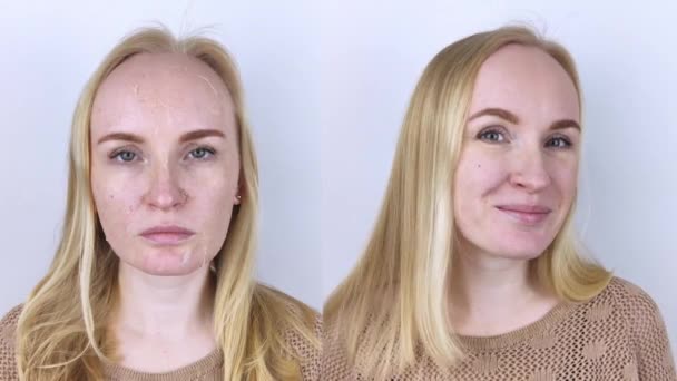 Voor Een Vrouw Onderzoekt Droge Huid Haar Gezicht Schillen Grof — Stockvideo
