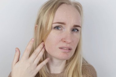 Bir kadın yüzündeki kuru deriyi muayene eder. Soyulma, kabalaşma, rahatsızlık, cilt hassasiyeti. Dermatolog ya da kozmetikçinin randevusundaki hasta. Kuru deri parçalarının yakın çekimi