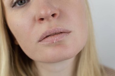 Bir kadın dudaklarındaki kuru deriyi inceliyor. Soyulma, kabalaşma, rahatsızlık, cilt hassasiyeti. Dermatolog ya da kozmetikçinin randevusundaki hasta. Kuru deri parçalarının yakın çekimi