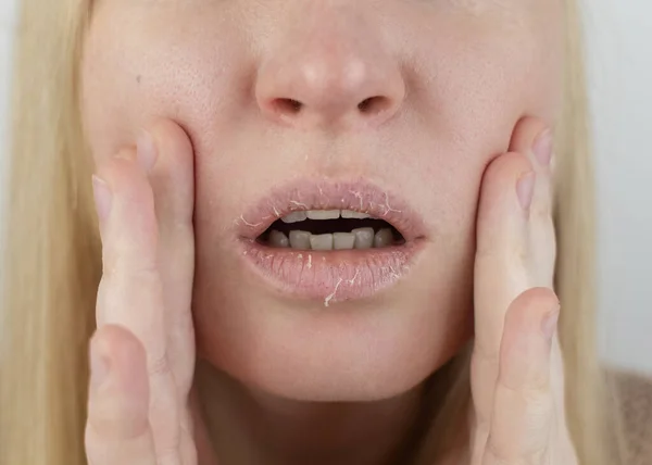 A woman examines dry skin on her lips. Peeling, coarsening, discomfort, skin sensitivity. Patient at the appointment of a dermatologist or cosmetologist. Close-up of pieces of dry skin