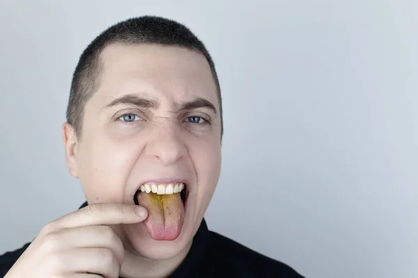 Man Has Yellow Tongue Painful Yellow Coating Mucous Membrane Tongue — Stock Photo, Image