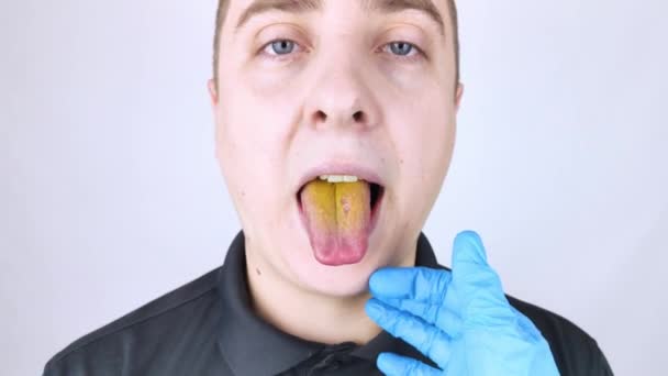 Hombre Tiene Una Lengua Amarilla Recubrimiento Amarillo Doloroso Membrana Mucosa — Vídeos de Stock