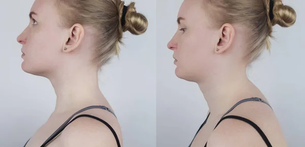 Kyphosis öncesi ve sonrası. Kadın, üst kısımdaki omurga kıvrımından muzdarip. Boyun omurları şişer ve bir kambur oluşturur. Eğim ve yanlış duruş tedavi kavramı