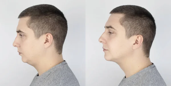 Elevador Barbilla Doble Antes Después Cirugía Plástica Mentoplastia Reconstrucción Facial —  Fotos de Stock
