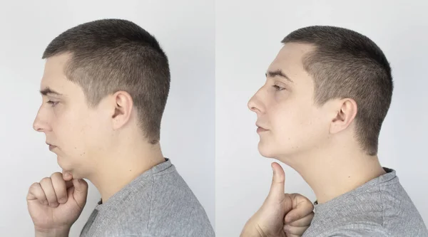 Elevador Barbilla Doble Antes Después Cirugía Plástica Mentoplastia Reconstrucción Facial — Foto de Stock