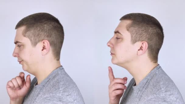 Doppeltes Klimmzüge Vor Und Nach Plastischen Chirurgie Mentoplastik Oder Gesichtsaufbau — Stockvideo
