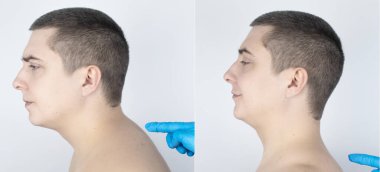 Kyphosis öncesi ve sonrası. Adam üst kısımdaki omurga kıvrımından muzdarip. Boyun omurları şişer ve bir kambur oluşturur. Eğim ve yanlış duruş tedavi kavramı