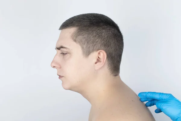 Kyphosis 这个人的上半部分脊椎曲率很高 颈椎隆起形成驼峰 曲率和不正确的姿势处理概念 — 图库照片