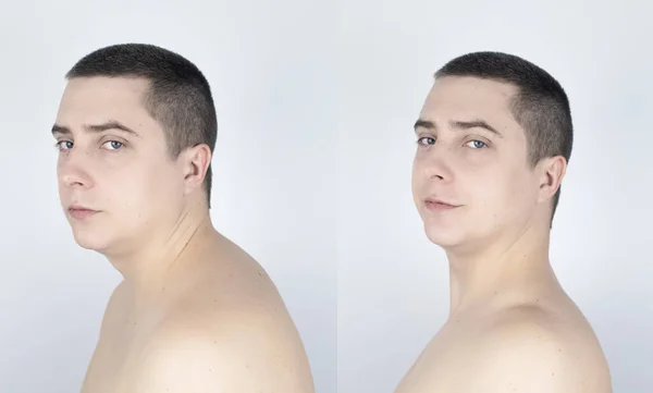 前とカイフォシス後 男は上部の背骨の曲率に苦しんでいます 子宮頸椎が膨らみ こぶを形成する カーバチュアと誤った姿勢治療の概念 — ストック写真