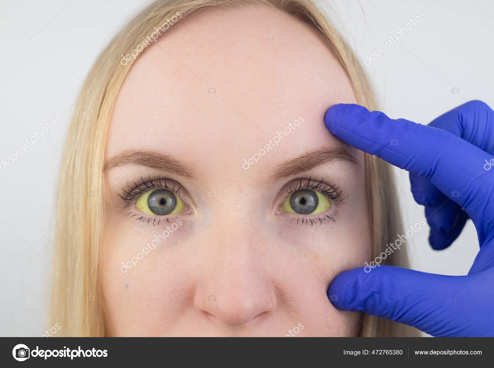 Yellow Color Woman Eye Symptom Jaundice Hepatitis Problems Gall Bladder