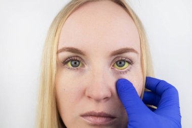 The yellow color of the woman eye. Symptom of jaundice, hepatiti clipart
