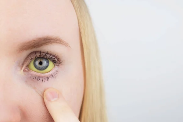 Die Gelbe Farbe Des Weiblichen Auges Symptome Von Gelbsucht Hepatitis — Stockfoto