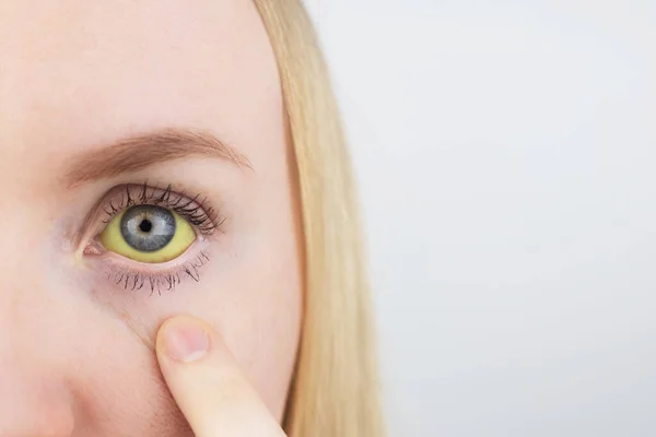 Gele Kleur Van Het Vrouwenoog Symptoom Van Geelzucht Hepatitis Problemen — Stockfoto