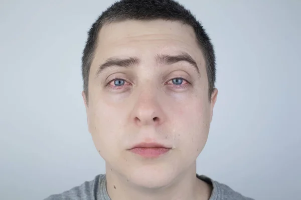 Close Dois Olhos Vermelhos Irritados Sangue Sexo Masculino Afetados Por — Fotografia de Stock