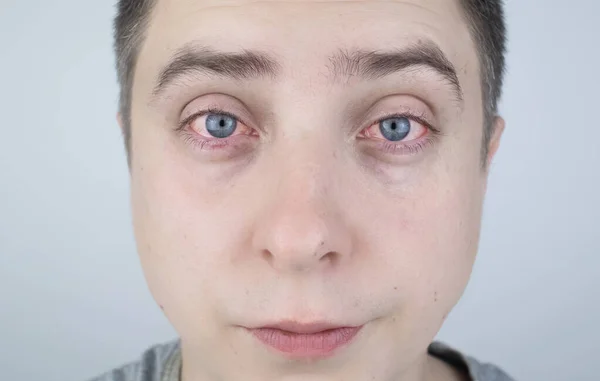 Zbliżenie Dwóch Rozdrażnionych Czerwonych Oczu Mężczyzn Dotkniętych Zapaleniem Spojówek Lub — Zdjęcie stockowe