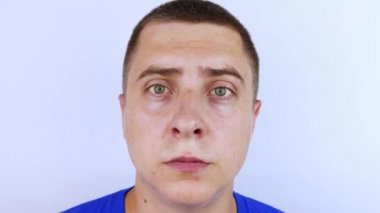 İnsan gözünün sarı rengi. Sarılık, hepatit veya safra kesesi, gastrointestinal ve karaciğer sorunları. Karaciğer, siroz, hepatit ve bilirubin hastalıklarında sarı göz.