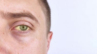 İnsan gözünün sarı rengi. Sarılık, hepatit veya safra kesesi, gastrointestinal ve karaciğer sorunları. Karaciğer, siroz, hepatit ve bilirubin hastalıklarında sarı göz.