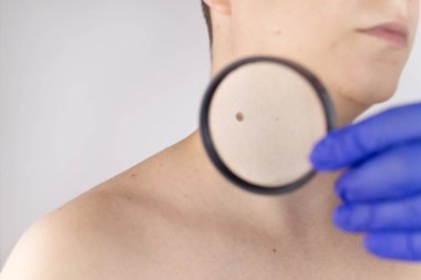 Dermatolog randevusundaki bir adam doğum lekelerini, benlerini ve nevi 'sini gösterir. Doktor dermatoskopla hastayı muayene ediyor. İyi huylu ve kötü huylu doğum lekeleri. Deri anormallikleri bakım konsepti