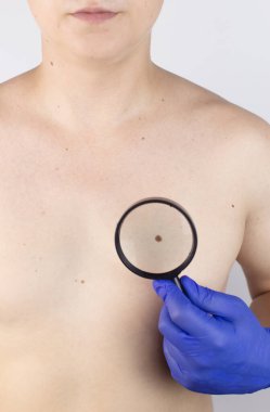 Dermatolog randevusundaki bir adam doğum lekelerini, benlerini ve nevi 'sini gösterir. Doktor dermatoskopla hastayı muayene ediyor. İyi huylu ve kötü huylu doğum lekeleri. Deri anormallikleri bakım konsepti