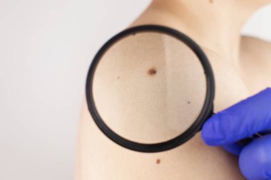 Dermatolog randevusundaki bir adam doğum lekelerini, benlerini ve nevi 'sini gösterir. Doktor dermatoskopla hastayı muayene ediyor. İyi huylu ve kötü huylu doğum lekeleri. Deri anormallikleri bakım konsepti