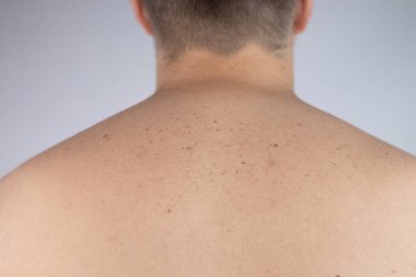Dermatolog randevusundaki bir adam doğum lekelerini, benlerini ve nevi 'sini gösterir. Doktor dermatoskopla hastayı muayene ediyor. İyi huylu ve kötü huylu doğum lekeleri. Deri anormallikleri bakım konsepti