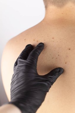 Dermatolog randevusundaki bir adam doğum lekelerini, benlerini ve nevi 'sini gösterir. Doktor dermatoskopla hastayı muayene ediyor. İyi huylu ve kötü huylu doğum lekeleri. Deri anormallikleri bakım konsepti