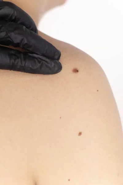 Hombre Una Cita Con Dermatólogo Muestra Sus Marcas Nacimiento Lunares —  Fotos de Stock