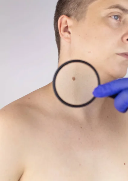 Man Dermatologist Appointment Shows His Birthmarks Moles Nevi Doctor Examines — Stock Photo, Image