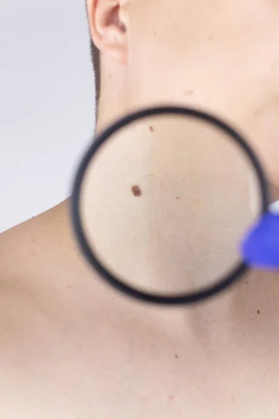 Man Dermatologist Appointment Shows His Birthmarks Moles Nevi Doctor Examines — Stock Photo, Image